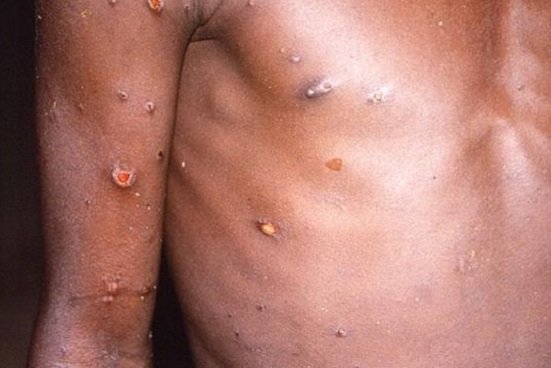 Reportan casos de viruela del mono en 12 países