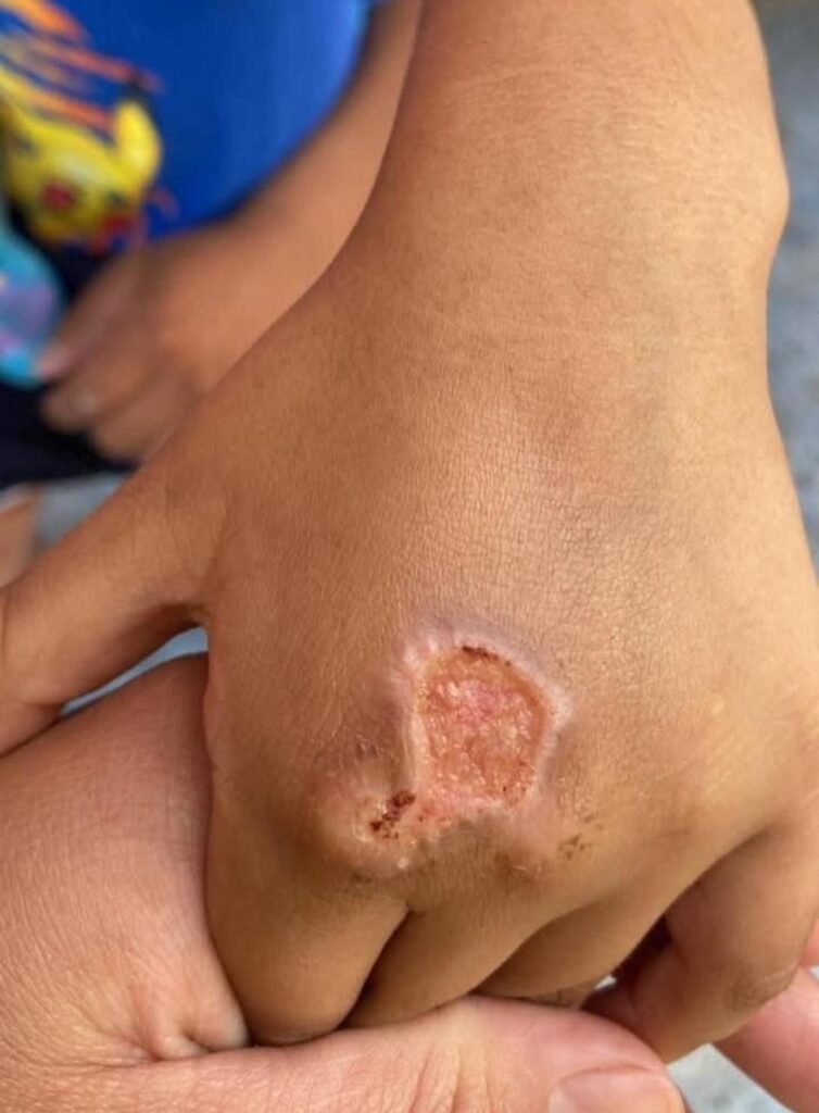 Padrastro quema las manos a dos niños de 6 y 4 años