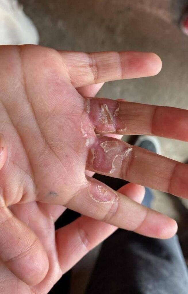 Padrastro quema las manos a dos niños de 6 y 4 años